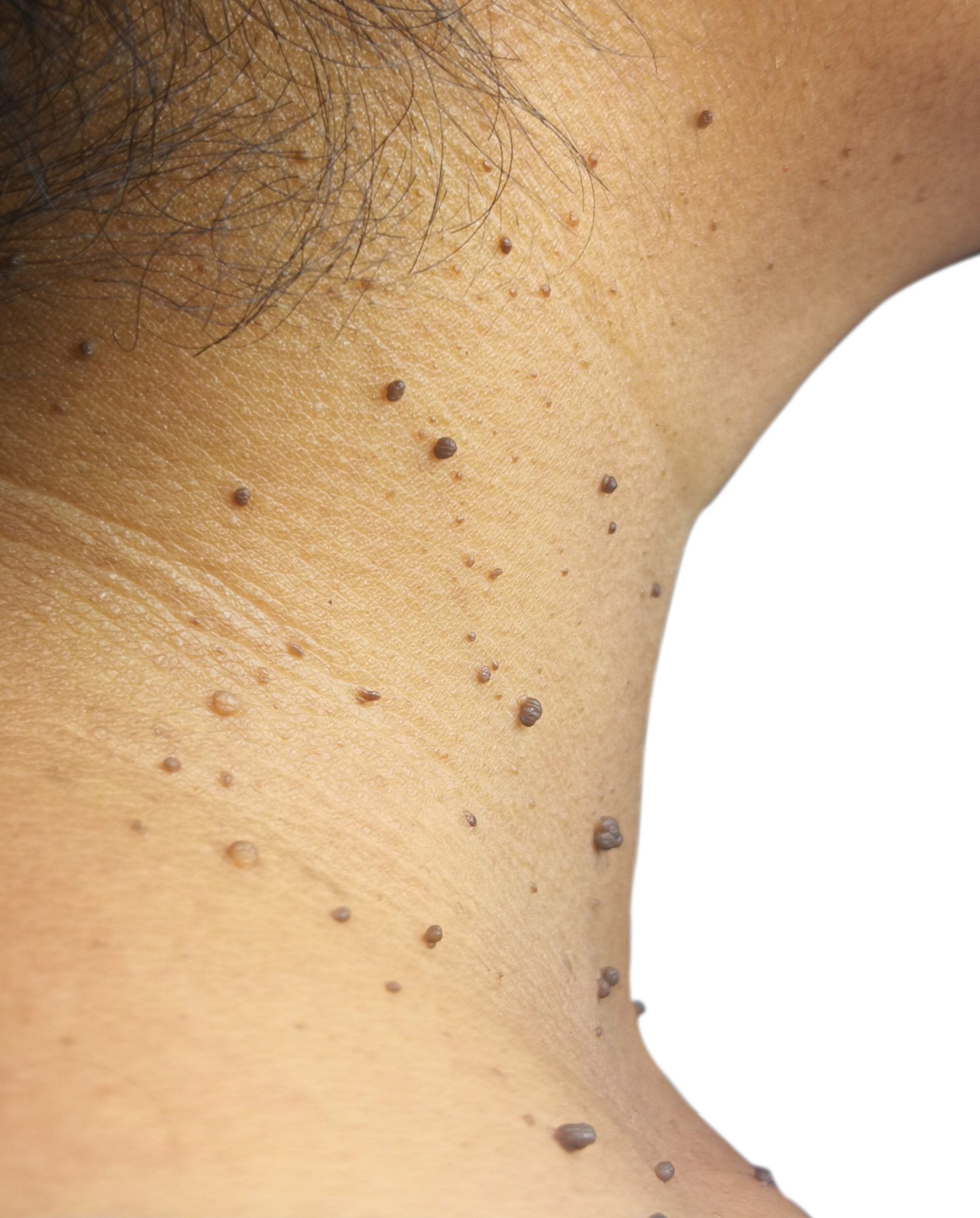 Skin on a neck with multiple small, dark, raised skin tags.