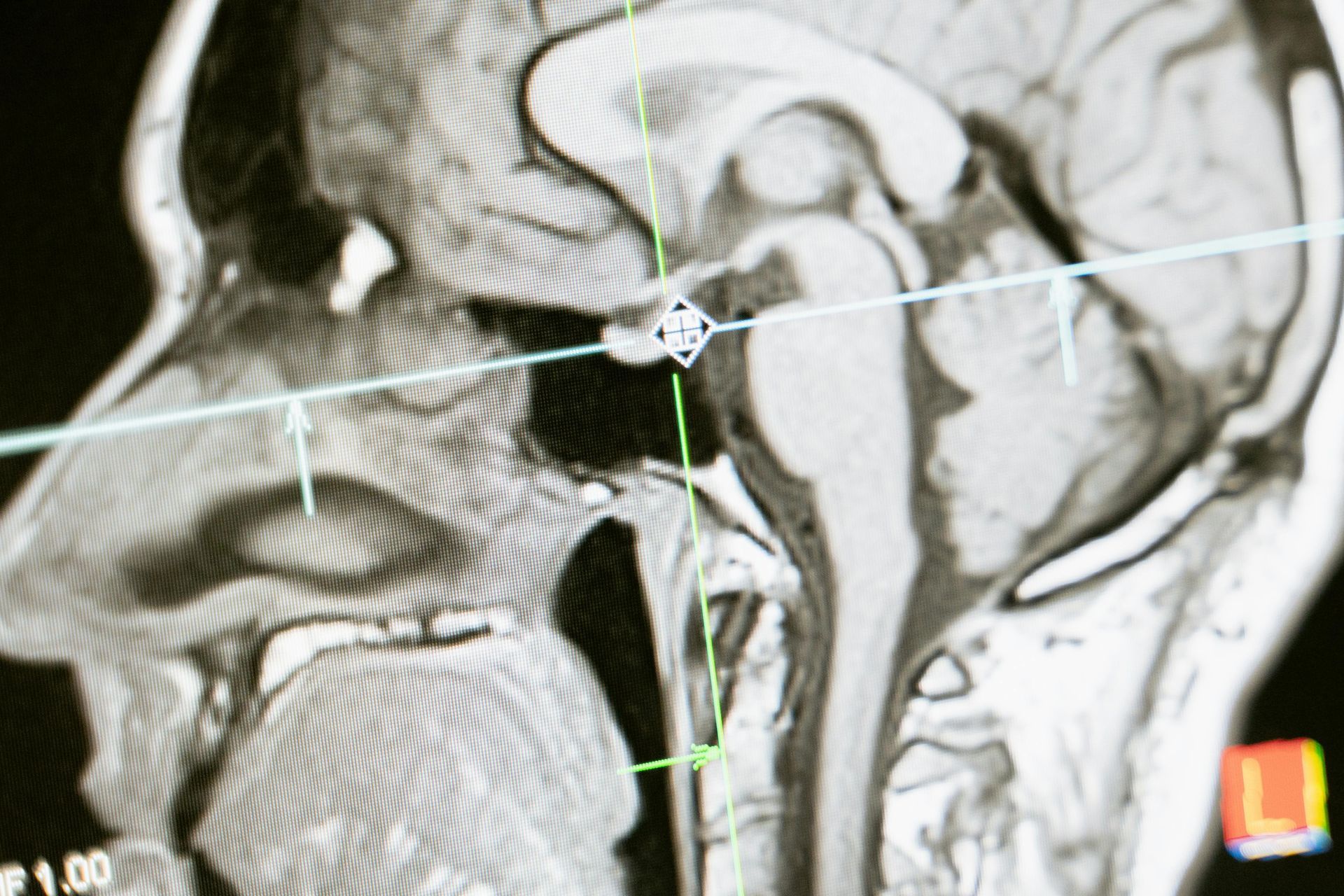 MRI scan of a human brain in profile; shows the brain stem, pituitary gland, and sinuses.