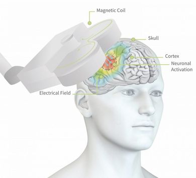 Man's head with brain stimulation. Magnetic coil above skull generates an electrical field, activating brain neurons.