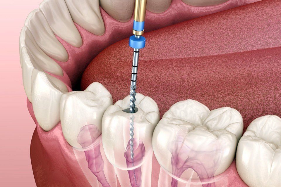 terapia canalare