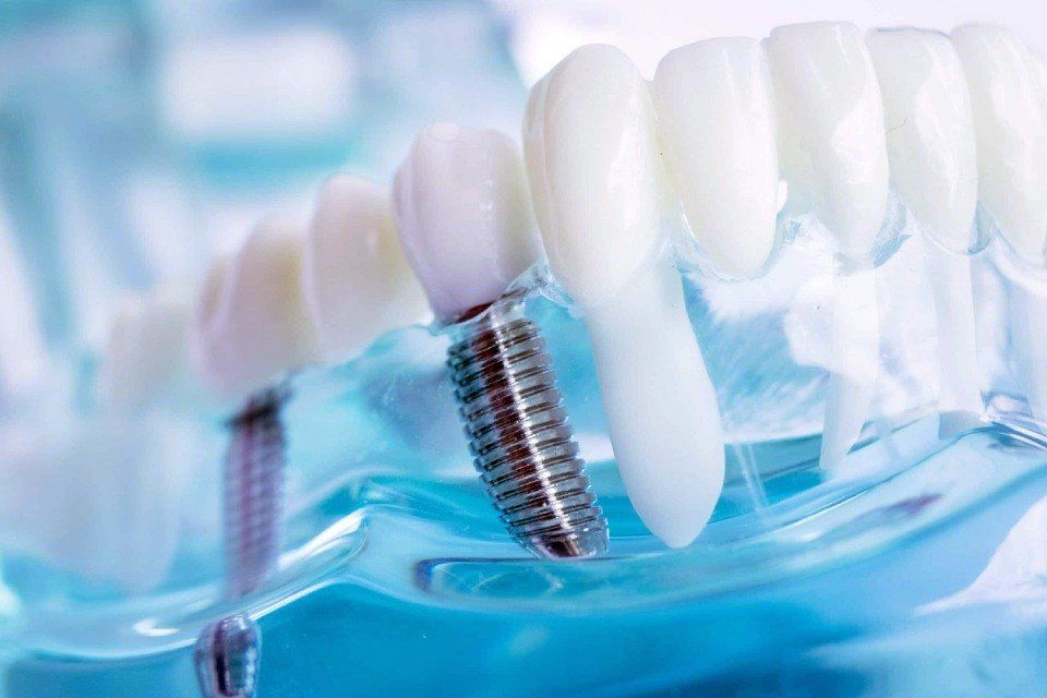 rappresentazione di un impianto dentale