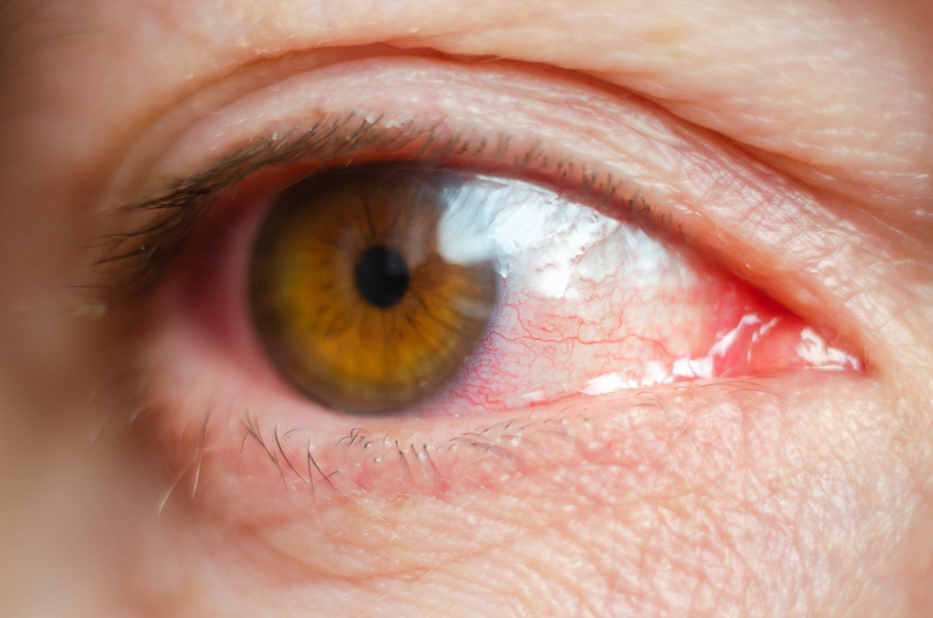 Quando é indicada a cirurgia de vitrectomia