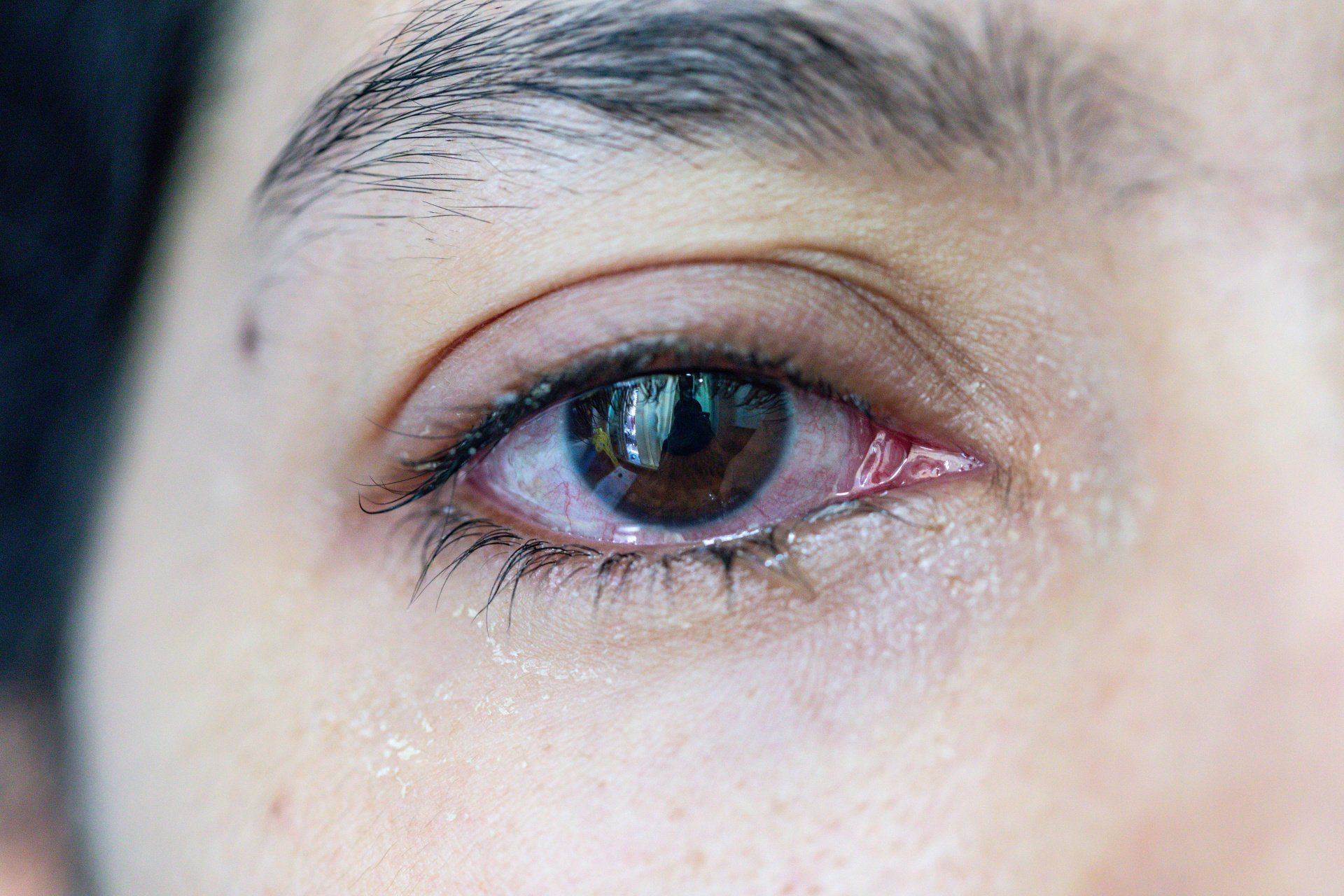 Tratamento para glaucoma Tratamento para glaucoma em Jundiaí
