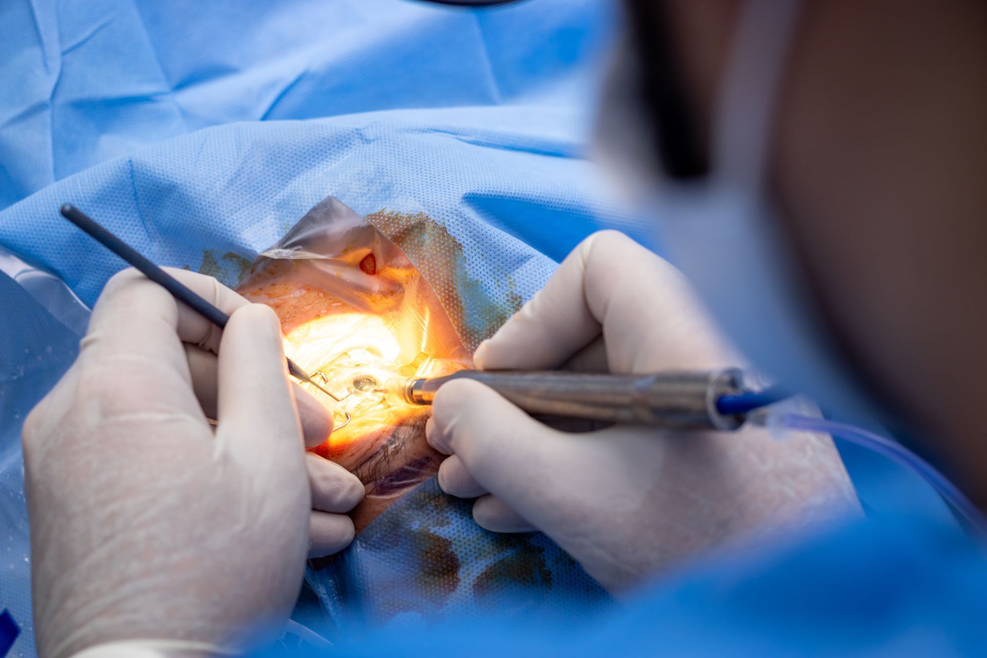É possível operar os dois olhos no mesmo dia na cirurgia de catarata