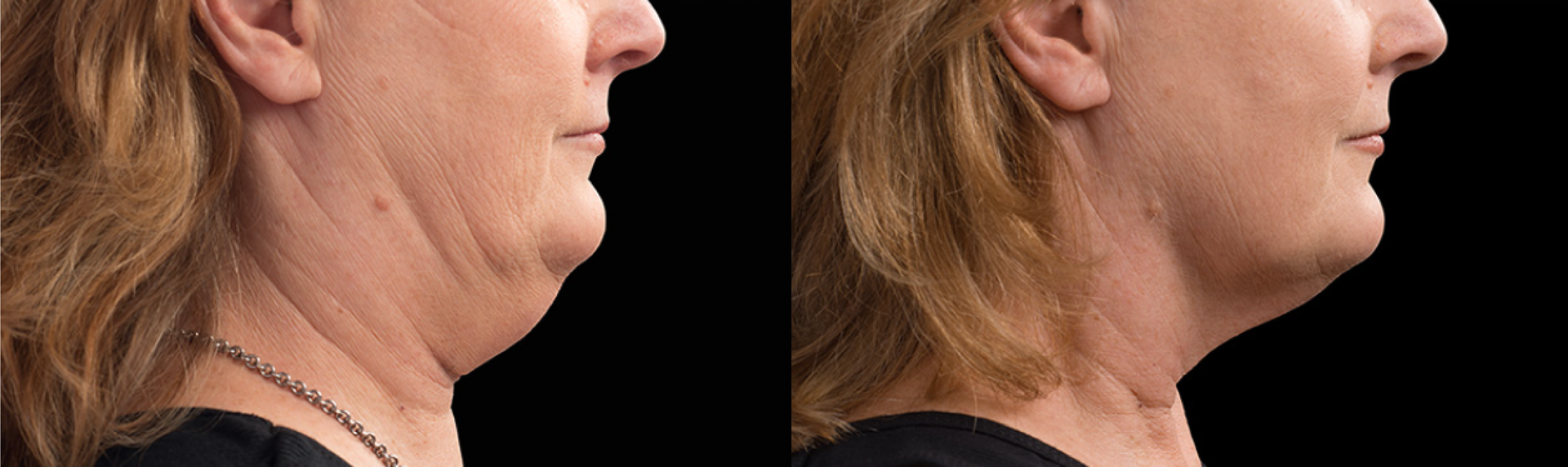 coolsculpting before and after