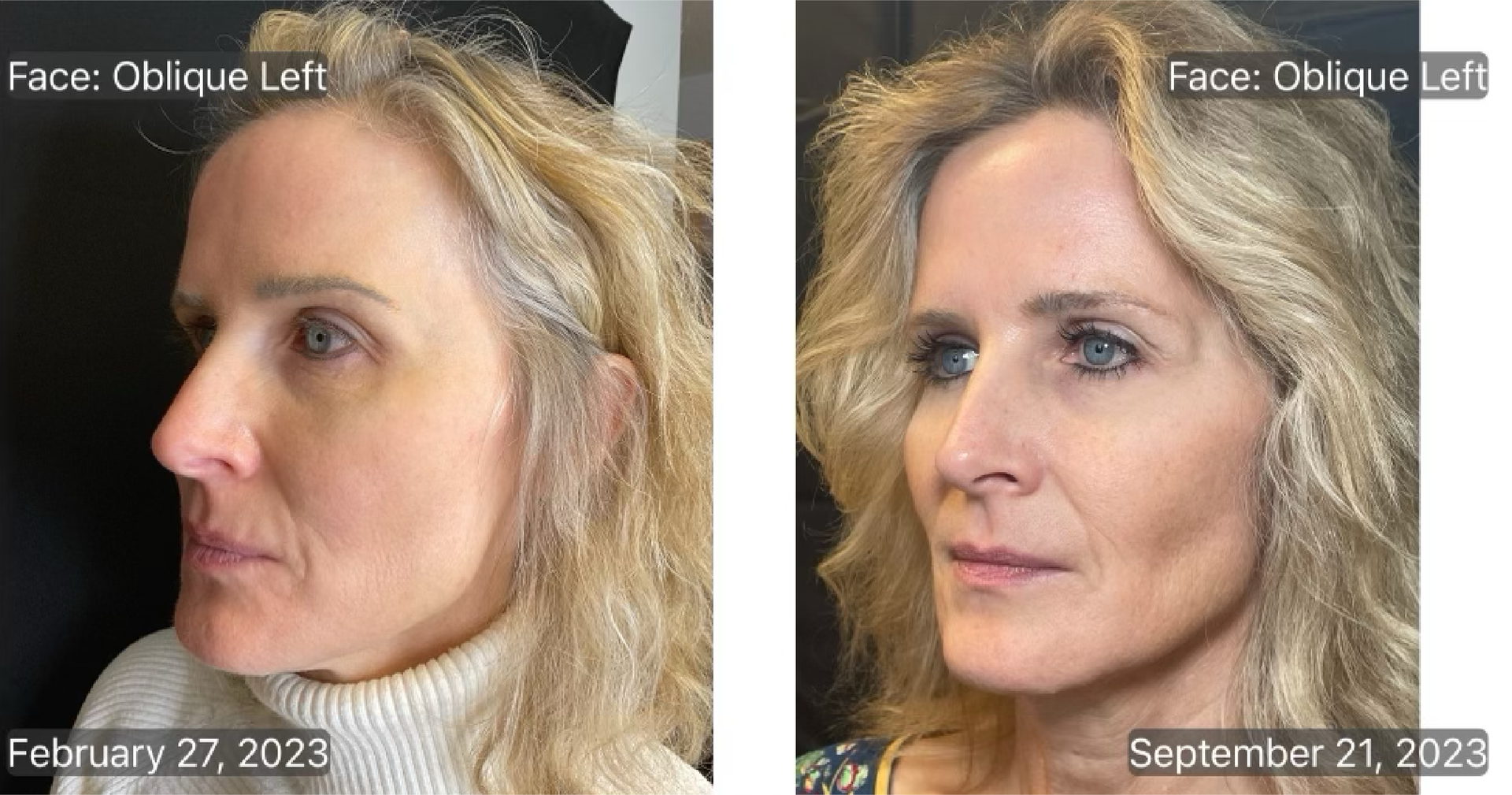 lasemd treatment at PSS
