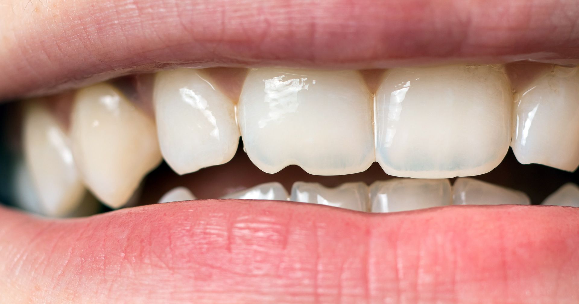 Roanoke VA dentist, emergency dental care Roanoke VA