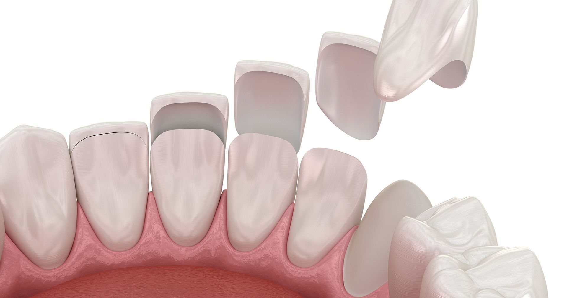 teeth under veneers