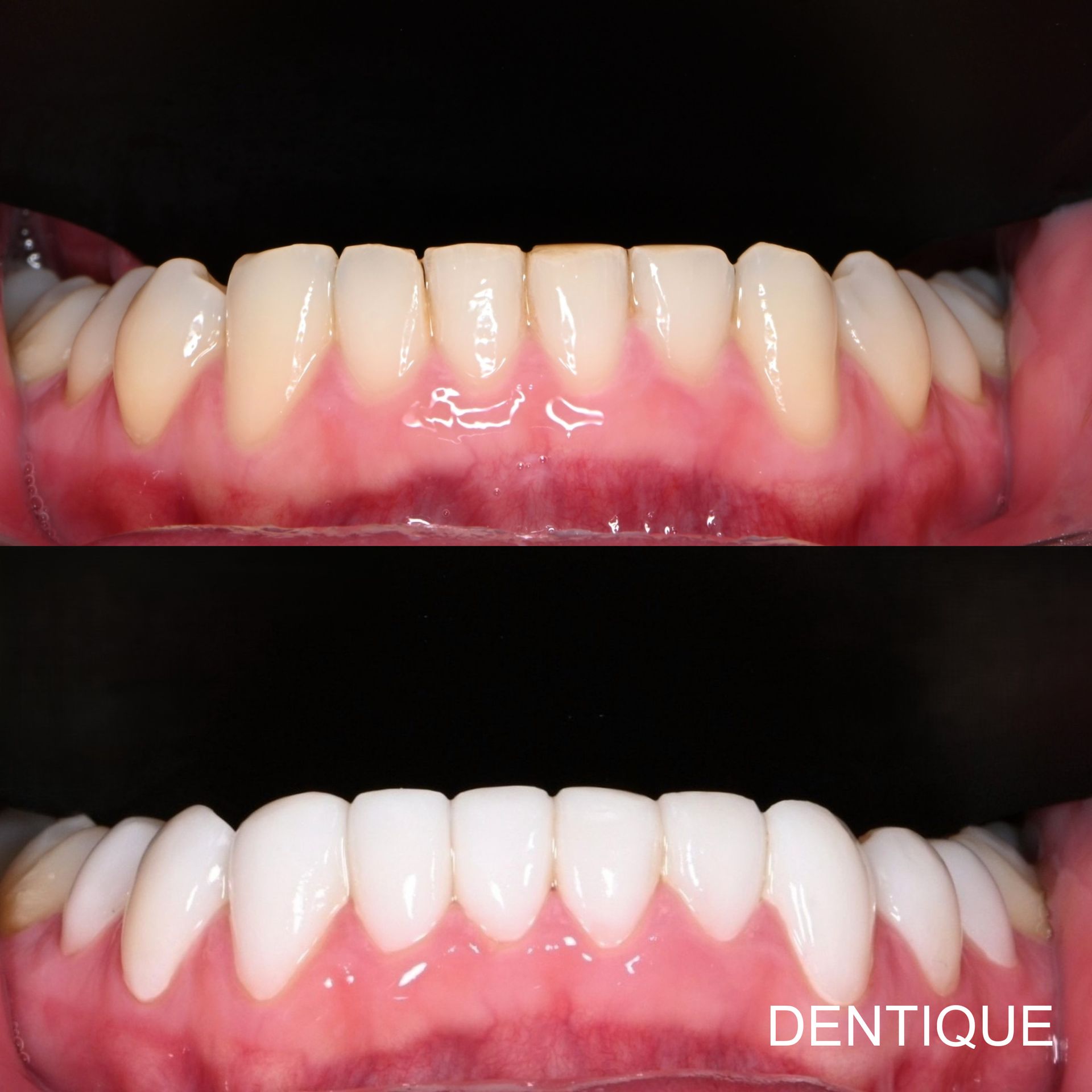 Before and after one-day cosmetic treatment at Dentique Dental Clinic in Gangnam, Seoul