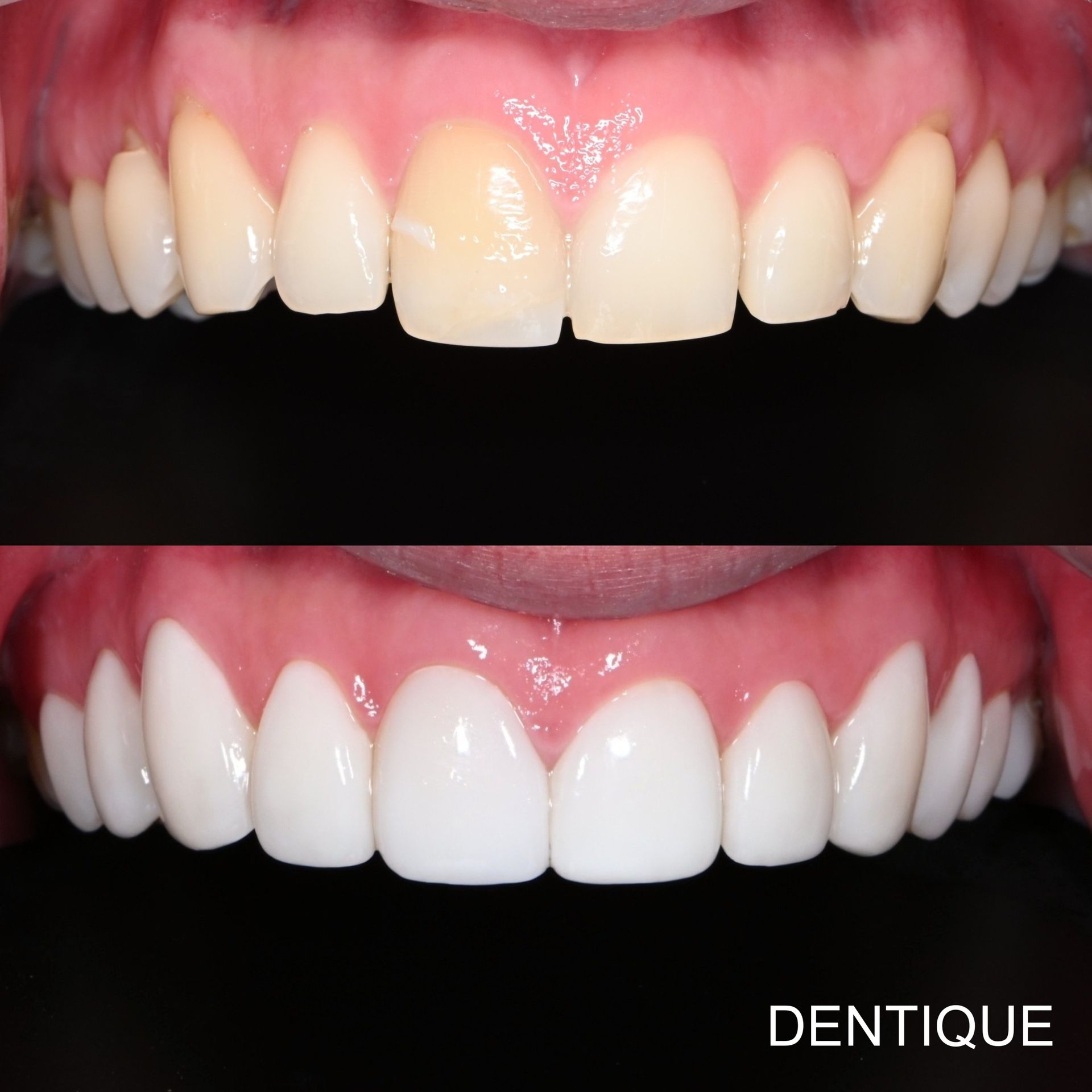 Before and after Zero Veneers at Dentique Dental Clinic in Gangnam, Seoul