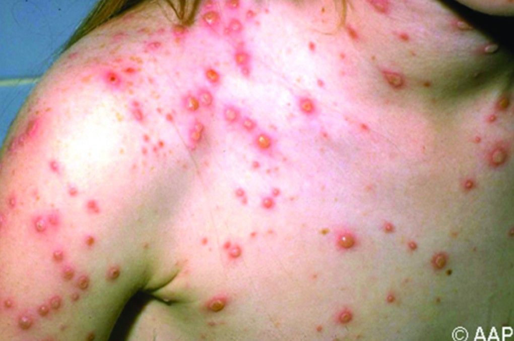 Teen with Varicella. Imagine if these lesions became infected.
