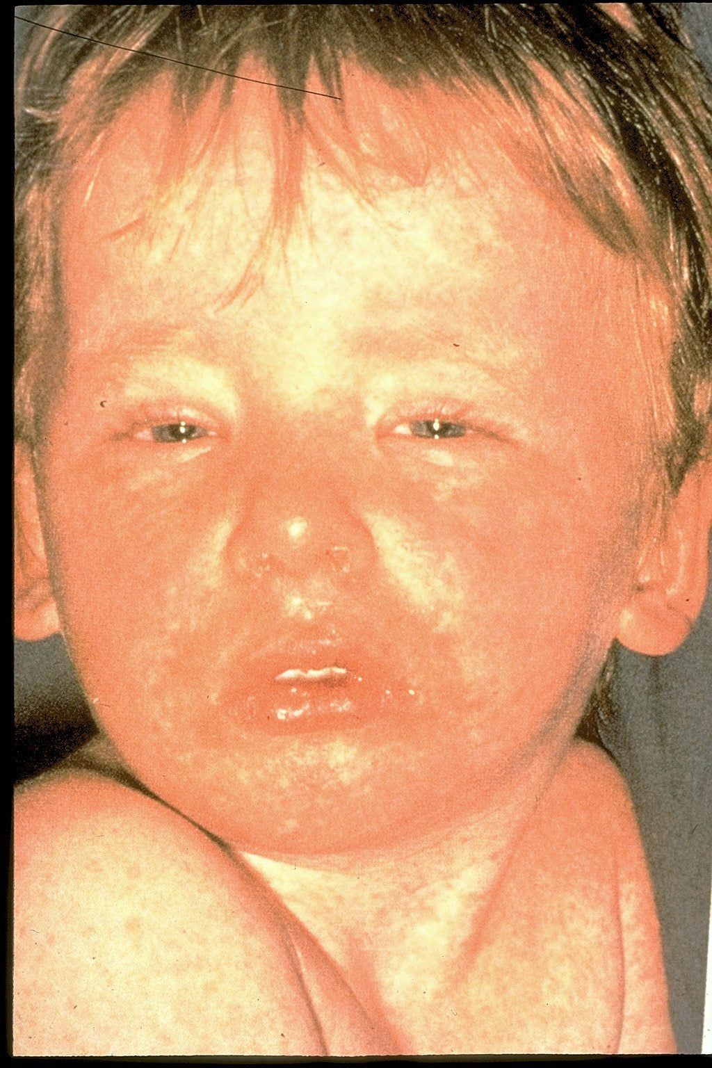 A flushed child with watery eyes and a red face, close-up portrait.