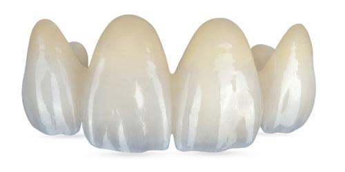 Dentist in Chester, VA: Porcelain fixed bridges, a service our dentist office provides