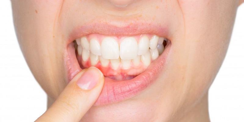 Dentist in Chester, VA: Person showing their periodontal disease, which our dentist office provides treatment for