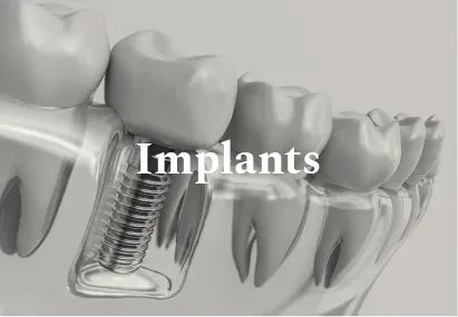 Dental implant illustration: a screw inserted into the jawbone with a crown replacing a missing tooth.