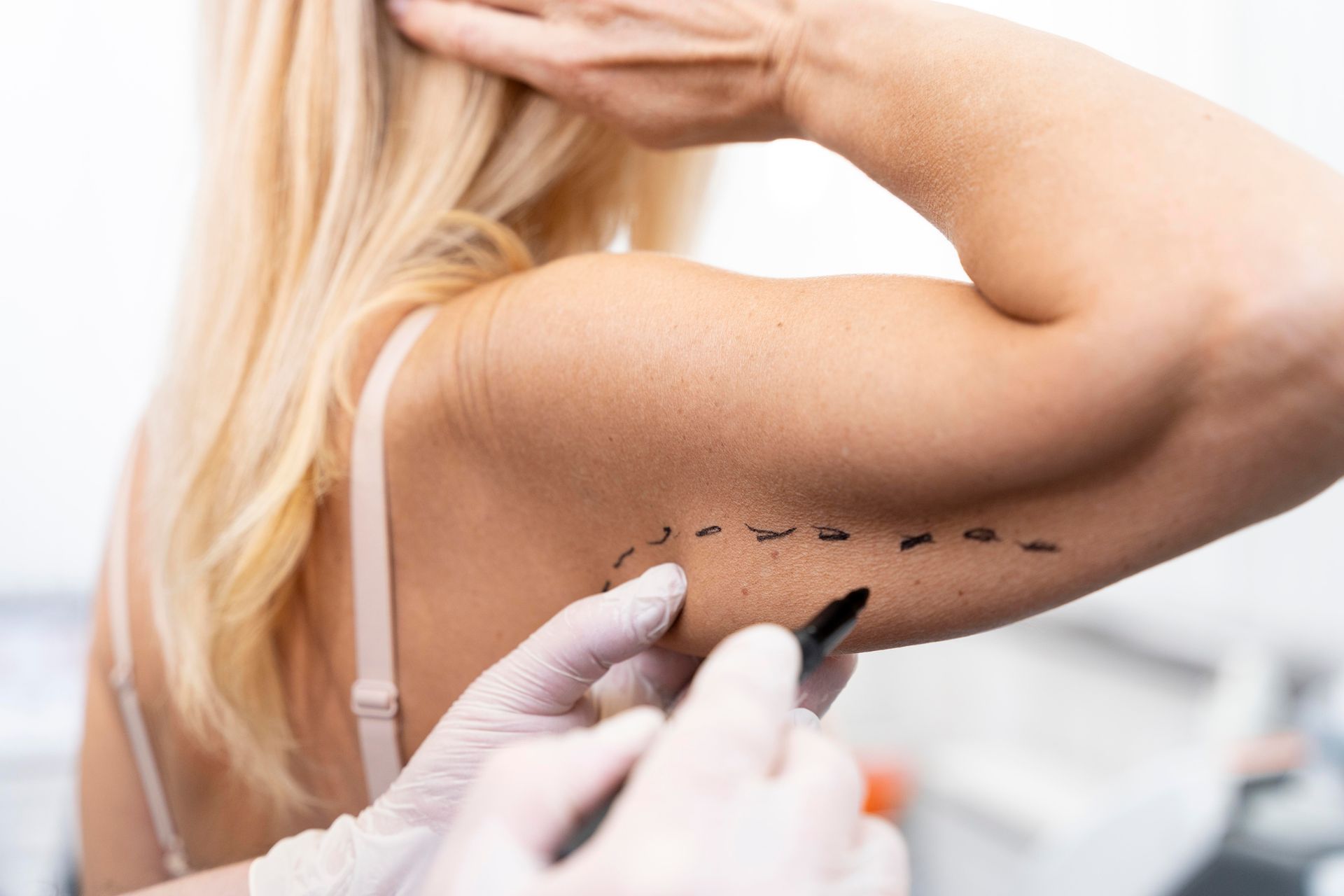 Arm with surgical markings; a doctor's hand draws on the skin, readying for a procedure.