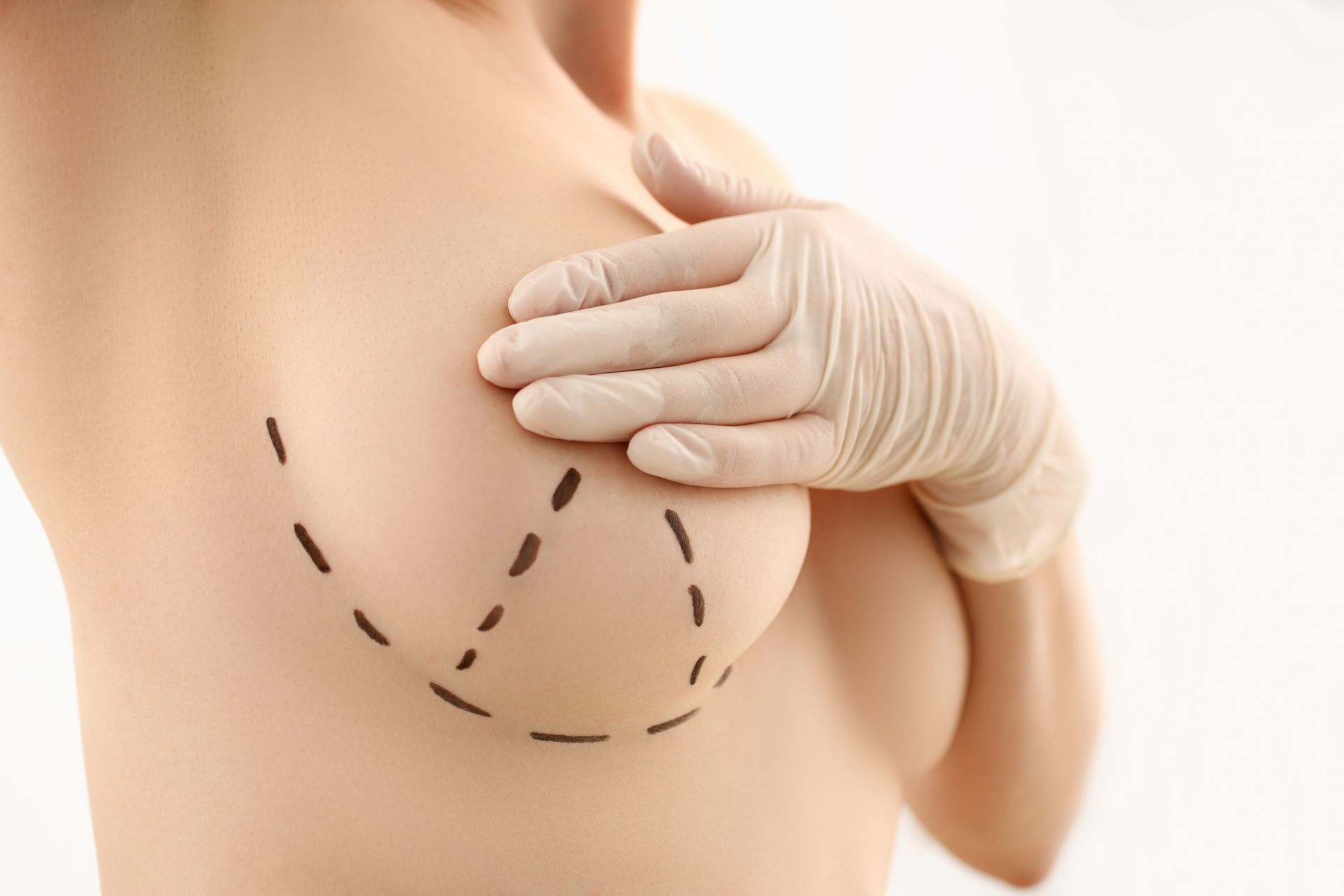 Woman's torso with surgical markings on breast, gloved hand touching.