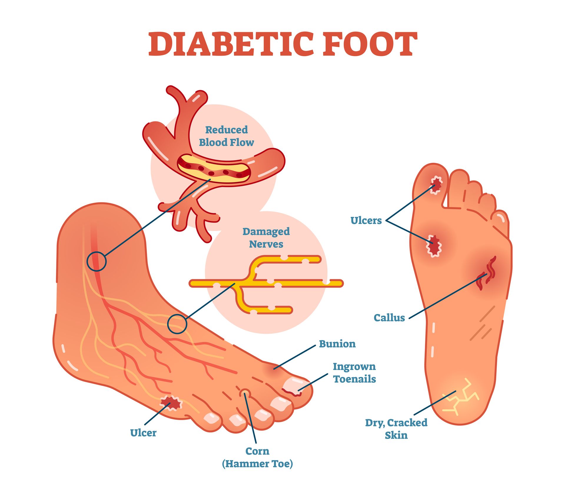 Foot Problem Diagram — Country Podiatry in South Tamworth, NSW