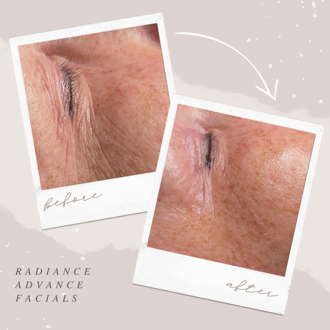 Before and after facial skin care result Radiant Beauty Lounge Roseville CA