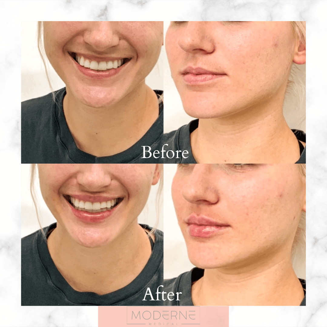 Before-and-after close-ups of a smiling mouth and profile view showing improved jawline contour.