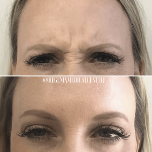 Close-up of a woman's eyes before and after wrinkle treatment, with smoother skin below.