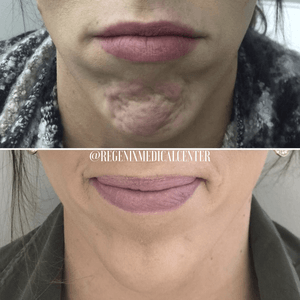 Split before-and-after close-up of a chin rash and a smoother, treated chin beneath a watermark