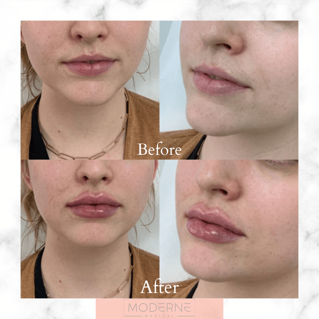 Before-and-after collage of lips and lower face showing a cosmetic result, with close-up side and front views.