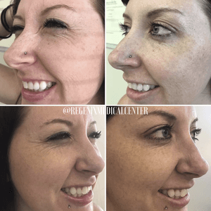 Four side-by-side profile photos of a smiling woman before and after cosmetic nose changes.