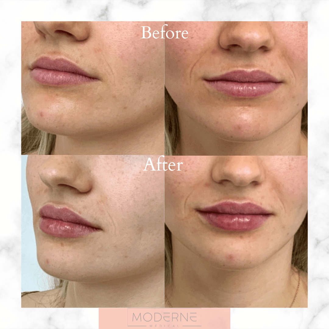 Before-and-after close-ups of lips and lower face showing a cosmetic treatment result.