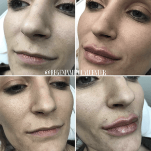 Four close-up facial photos showing before-and-after lip enhancement results
