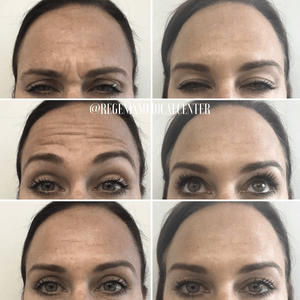 Before-and-after collage of a woman's eyebrows and eyes showing brow lift results.