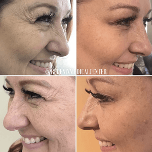 Side-by-side close-up face profile comparison showing skin smoothing and reduced wrinkles after treatment