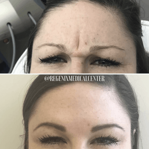 Before-and-after close-up of forehead and eyes, showing reduced wrinkles and smoother skin.