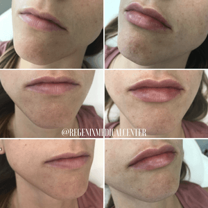 Before-and-after collage of close-up lips and chin showing different angles after cosmetic treatment