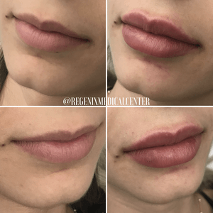 Before-and-after close-up collage of lips with fuller pink lip filler results