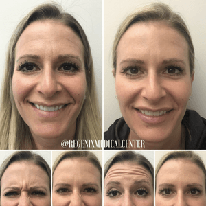 Before-and-after collage of a woman's face showing frown lines smoothed after treatment