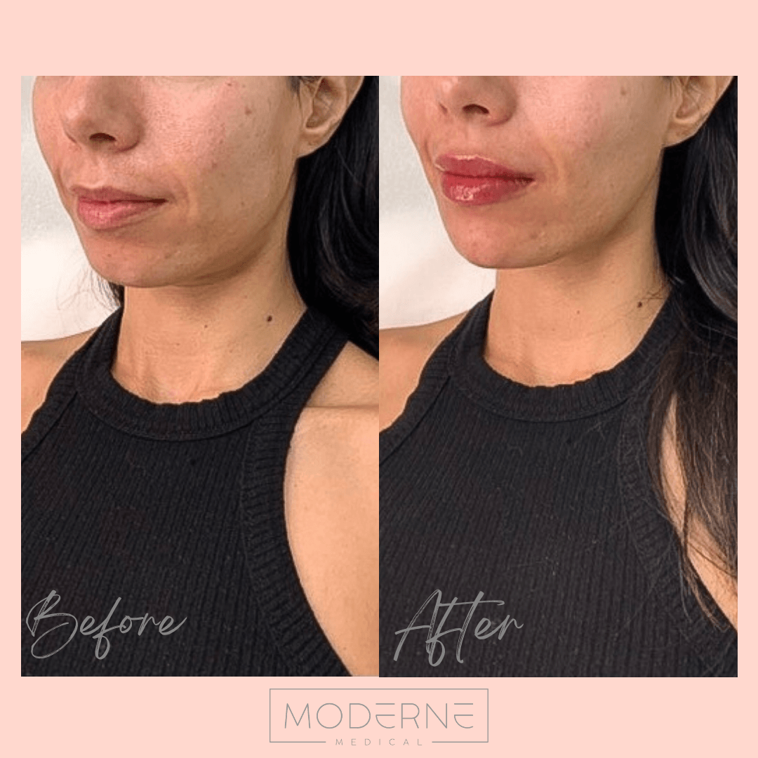 Before-and-after close-up of a woman's cheek showing reduced acne marks and smoother skin.