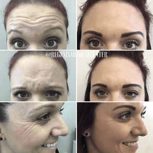 Before-and-after collage of a forehead and brow lift showing smoother forehead and raised eyebrows after treatment