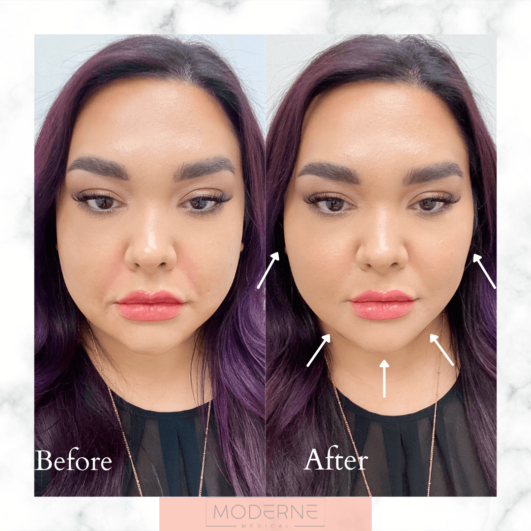 Before-and-after facial comparison with arrows highlighting jawline and chin contour changes