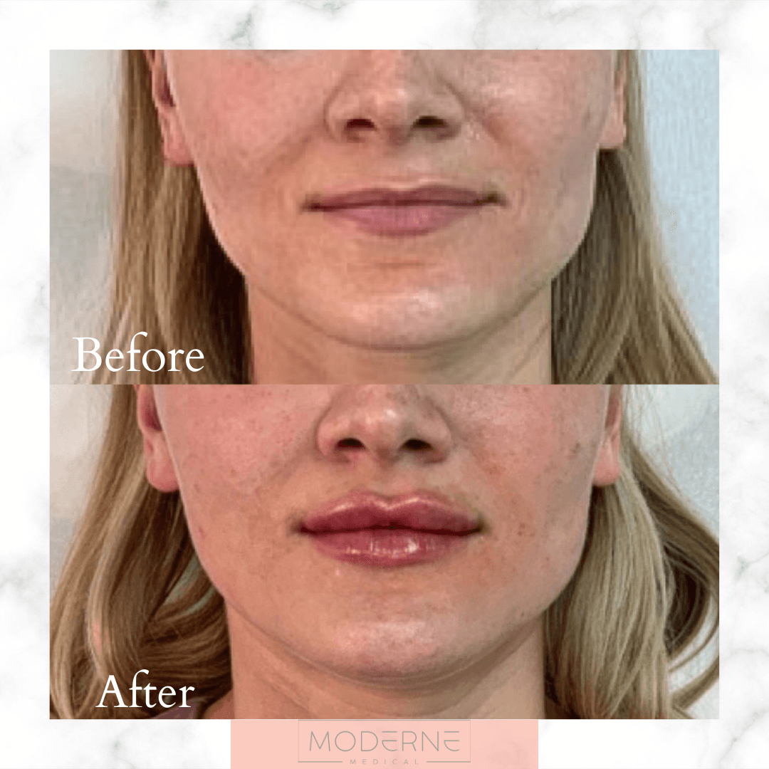 Before-and-after close-up of lips and lower face showing cosmetic enhancement, with glossier lips after.