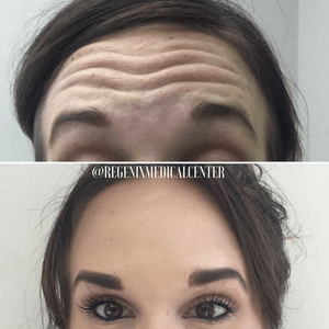 Forehead before-and-after comparison showing fewer wrinkles and smoother skin