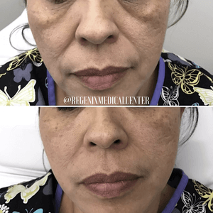 Front-facing close-up of a person’s lower face, shown in before-and-after comparison.