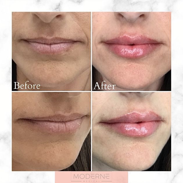 Before-and-after close-up lips: top left before, top right after; bottom shows side-by-side comparison.