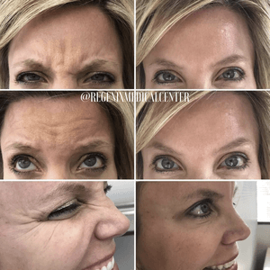 Collage of a woman’s face showing eyebrow wrinkles before and after cosmetic treatment