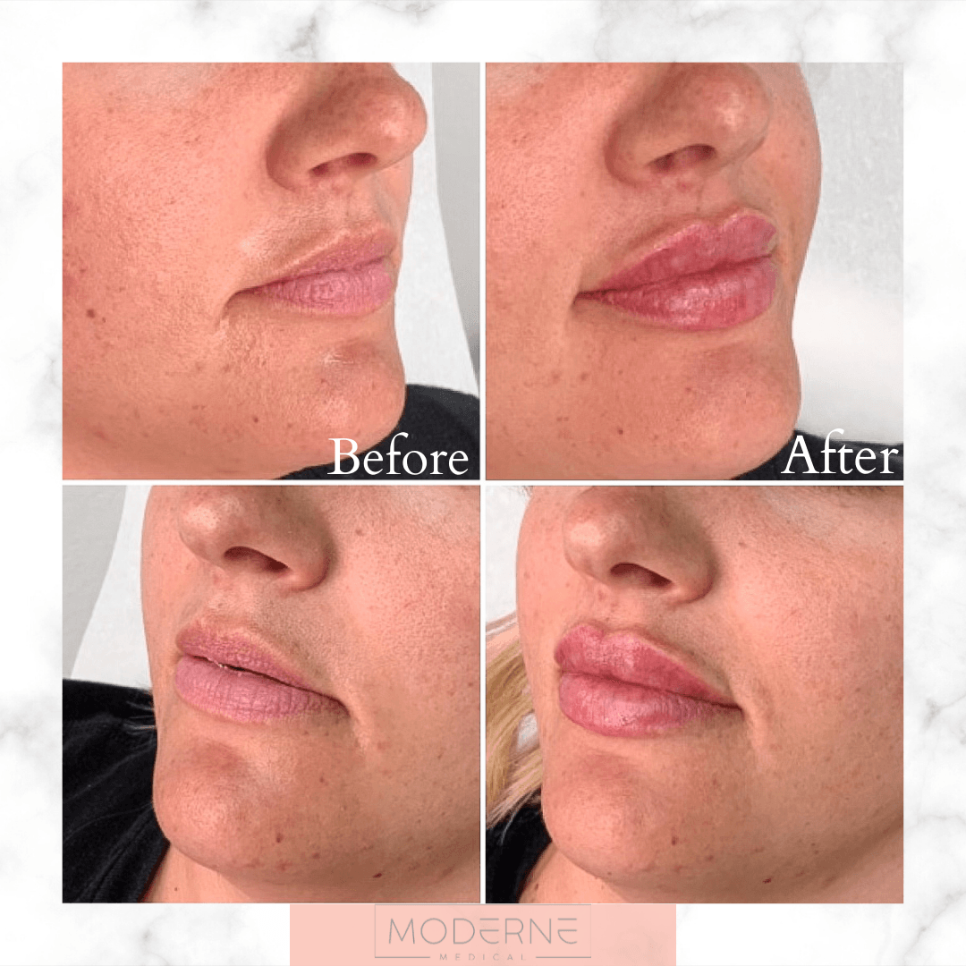 Collage of lip close-ups showing before and after cosmetic filler results on the lower face