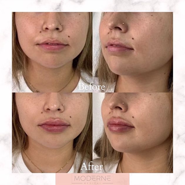 Before-and-after collage of a woman’s nose and lips from front and side views.