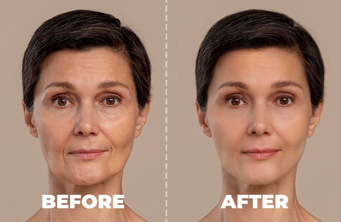 Radiesse Treatment in Scottsdale