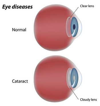 Diagram comparing a normal eye with a cataract eye, showing a clear lens vs. a cloudy lens.