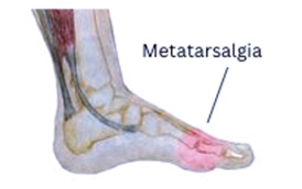 Metatarsalgia