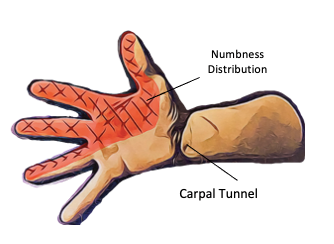 Carpal Tunnel Syndrome